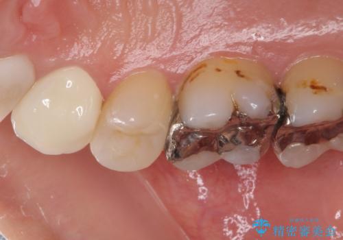 痛みが続く銀歯をセラミックにの治療後