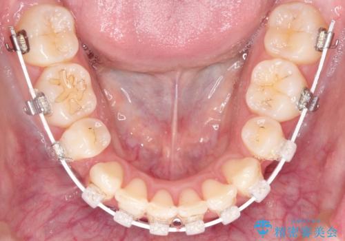 前歯のガタガタと出っ歯が気になる ハーフリンガルによる抜歯矯正の治療中
