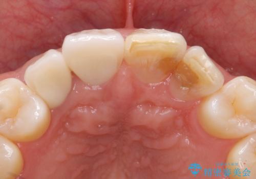奥に引っ込んでいる歯をセラミックでかぶせたい 補綴前矯正 50代男性の治療後