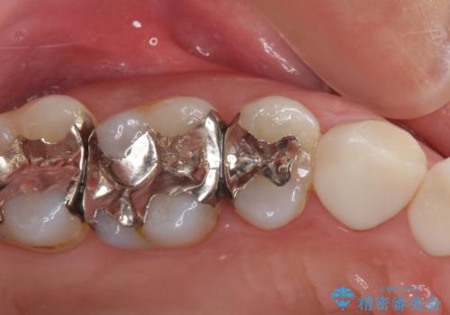痛みが続く銀歯をセラミックにの症例 治療前