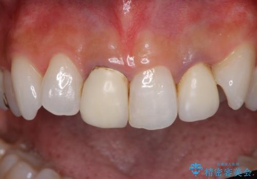 裏打ちが金属のセラミッククラウンをオールセラミッククラウンで自然にの治療前