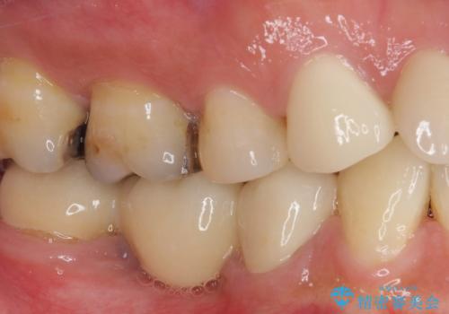 痛みが続く銀歯をセラミックにの治療後
