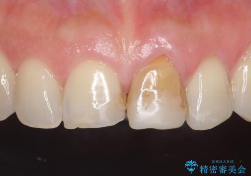オールセラミッククラウン 変色が気になる前歯の治療の治療前