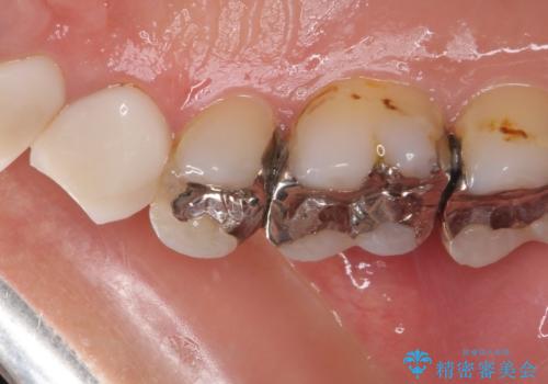 痛みが続く銀歯をセラミックにの治療前