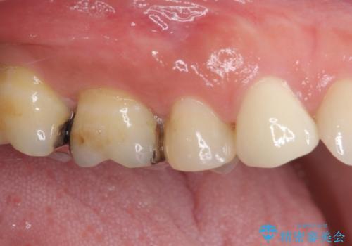 痛みが続く銀歯をセラミックにの治療後