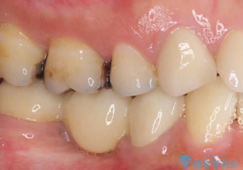痛みが続く銀歯をセラミックにの治療前