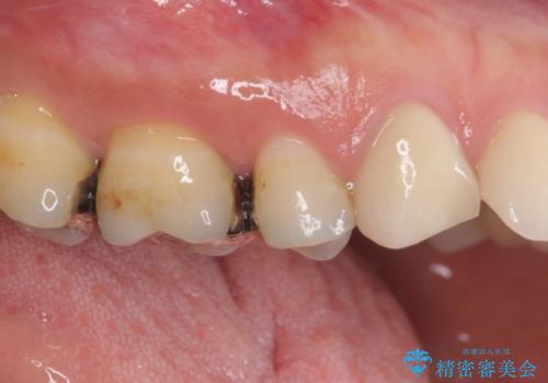 痛みが続く銀歯をセラミックにの治療前