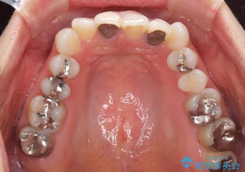 裏打ちが金属のセラミッククラウンをオールセラミッククラウンで自然にの治療前