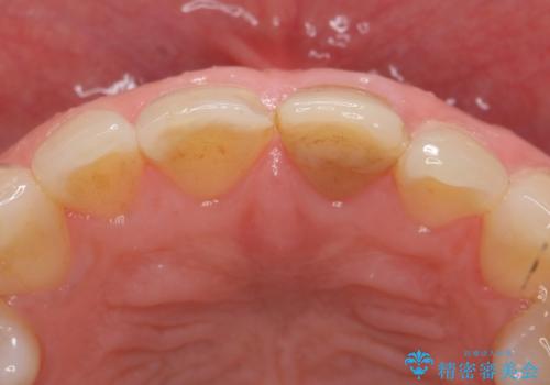 オールセラミッククラウン 変色が気になる前歯の治療の治療前