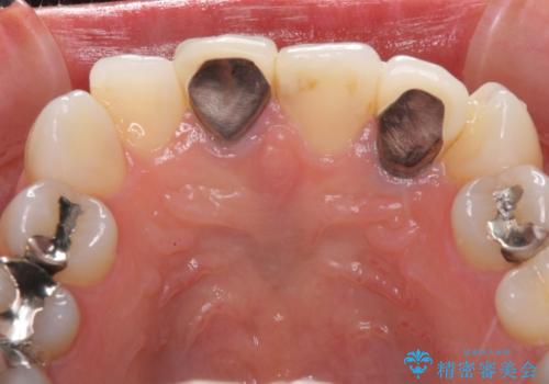 裏打ちが金属のセラミッククラウンをオールセラミッククラウンで自然にの治療前