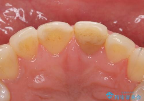 オールセラミッククラウン 変色が気になる前歯の治療の治療前