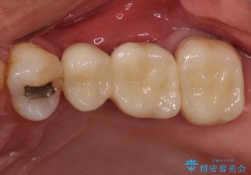 部分矯正を併用した奥歯のインプラント補綴治療の治療後