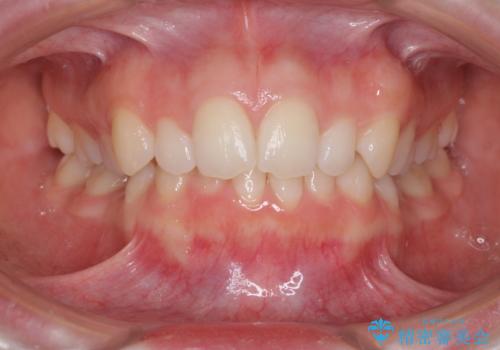 インビザラインでデコボコを目立たず矯正の治療前