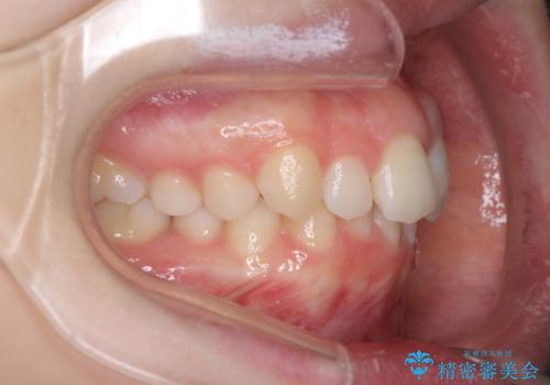 インビザラインでデコボコを目立たず矯正の症例 治療前