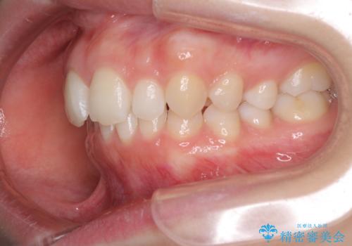 インビザラインでデコボコを目立たず矯正の治療前