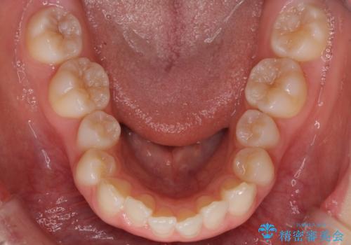 インビザラインでデコボコを目立たず矯正の治療前