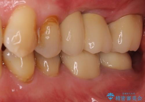 部分矯正を併用した奥歯のインプラント補綴治療の症例 治療後