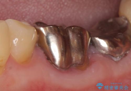 オールセラミッククラウン 外れてしまった銀歯の治療の治療前