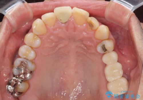 部分矯正を併用した奥歯のインプラント補綴治療の治療後