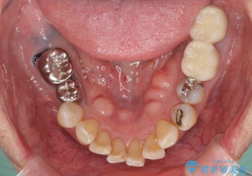 部分矯正を併用した奥歯のインプラント補綴治療の治療後
