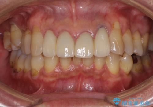 歯が痛い　前歯のセラミック治療の治療前