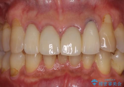 歯が痛い 前歯のセラミック治療の治療前