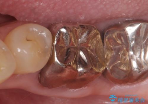 オールセラミッククラウン 外れてしまった銀歯の治療の治療前