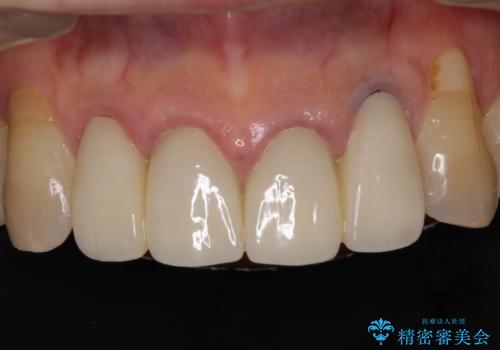 歯が痛い 前歯のセラミック治療の症例 治療前