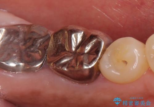 オールセラミッククラウン 外れてしまった銀歯の治療の治療前