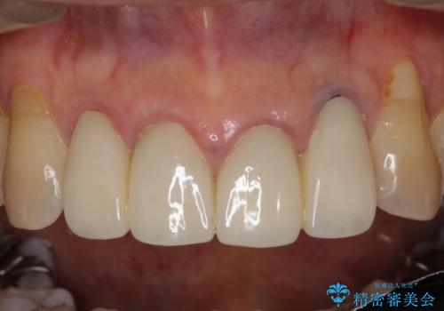 歯が痛い 前歯のセラミック治療の治療前