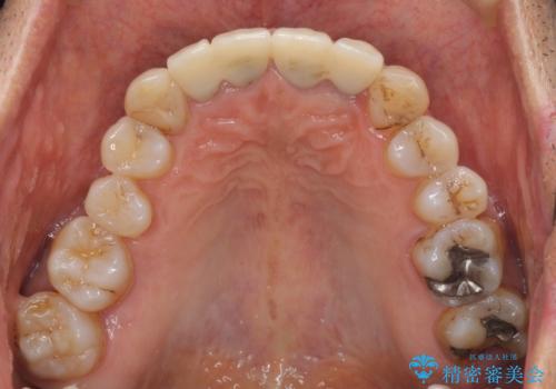 歯が痛い 前歯のセラミック治療の治療前