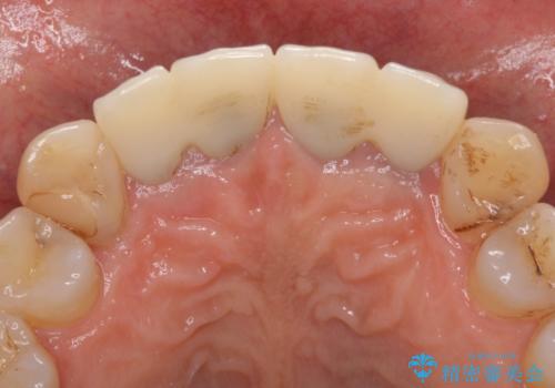 歯が痛い 前歯のセラミック治療の治療前