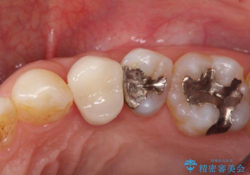 深いむし歯。根本的な治療の症例 治療後
