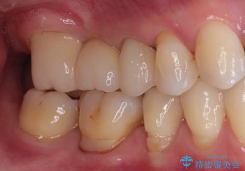 奥歯のオールセラミックブリッジの治療後