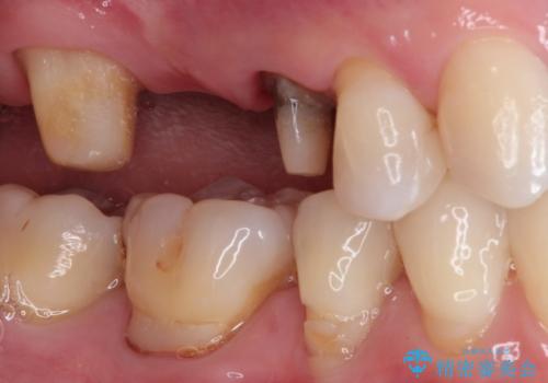 奥歯のオールセラミックブリッジの治療中