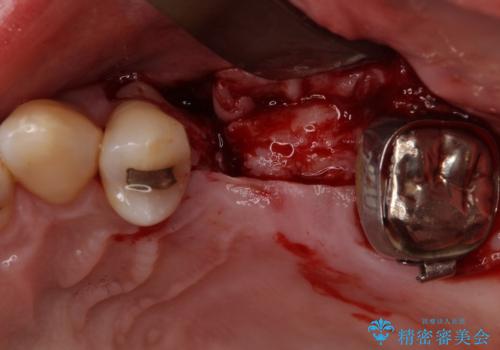 部分矯正を併用した奥歯のインプラント補綴治療の治療後