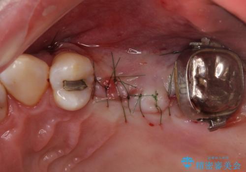 部分矯正を併用した奥歯のインプラント補綴治療の治療中