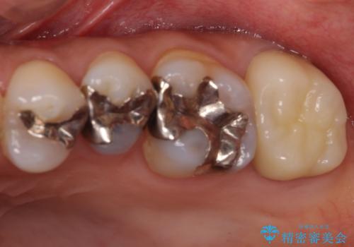 奥歯の虫歯と歯茎の腫れをセラミッククラウンで治療の治療後