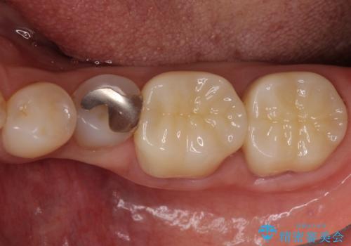 奥歯の虫歯と歯茎の腫れをセラミッククラウンで治療の治療後