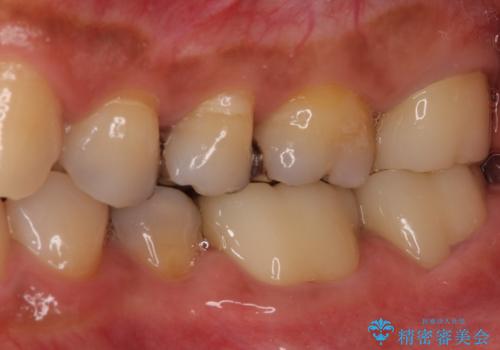 奥歯の虫歯と歯茎の腫れをセラミッククラウンで治療の治療後