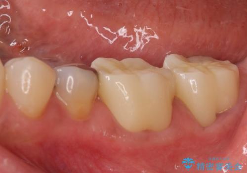 奥歯の虫歯と歯茎の腫れをセラミッククラウンで治療