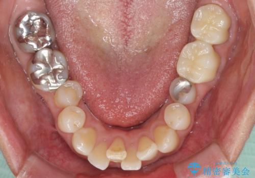 奥歯の虫歯と歯茎の腫れをセラミッククラウンで治療の治療後