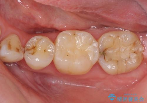 奥歯の虫歯をセラミックインレーにて修復治療