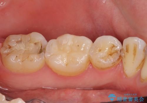 奥歯の虫歯をセラミックインレーにて修復治療の治療後