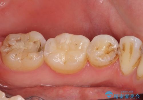 奥歯の虫歯をセラミックインレーにて修復治療の治療後