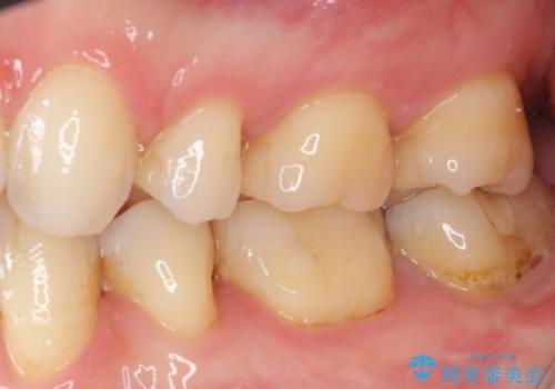 奥歯の虫歯をセラミックインレーにて修復治療の治療後