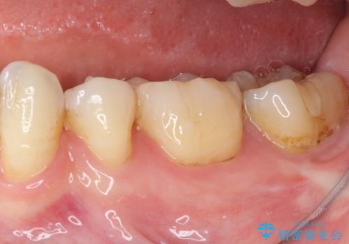 奥歯の虫歯をセラミックインレーにて修復治療の治療後