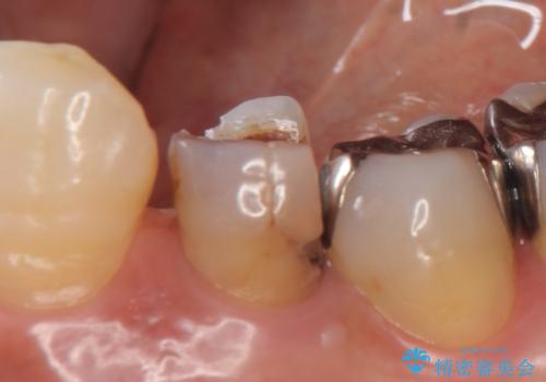 オールセラミッククラウン 疼きの治まらない歯の治療の治療前