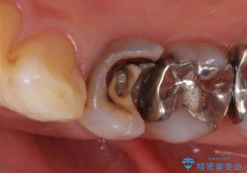 オールセラミッククラウン 疼きの治まらない歯の治療の治療前
