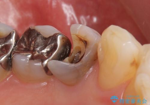 オールセラミッククラウン 疼きの治まらない歯の治療の治療前